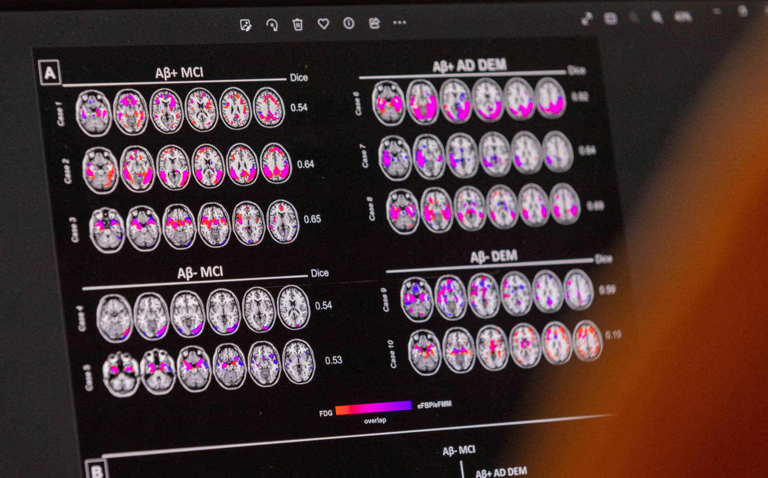 File Photo: A Scientist Looks At Hypometabolic And Hypoperfusion Patterns At The Single Subject Level From A Patient Suffering From Alzheimer's Disease At The Memory Centre At The Department Of Readaptation And Geriatrics Of The University Hospital (hug) I