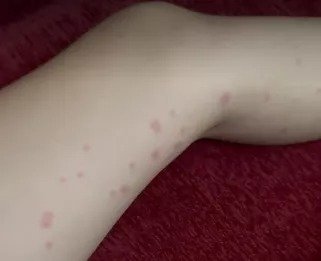 Limassol sees rise in skin rashes, likely caused by sand fleas | en ...