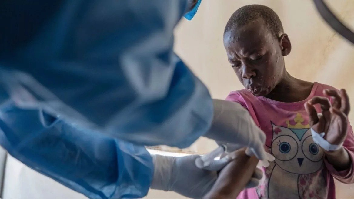 Mpox Outbreak Claims Over 850 Lives In Africa, Remains Uncontrolled