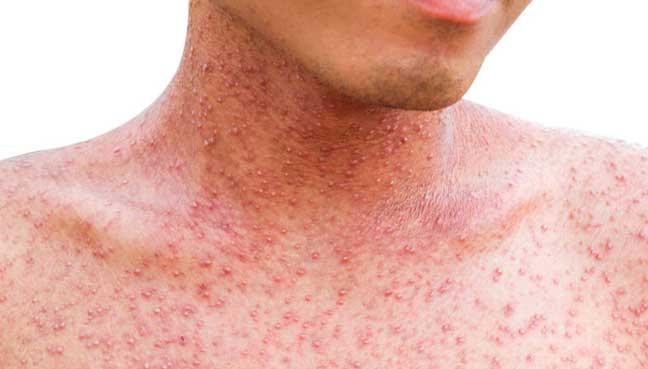 Measles